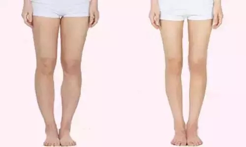 <a href='/cq/' target='_blank'><u>重慶美萊</u></a>做抽脂手術怎么樣?