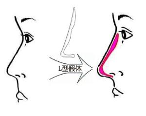 深圳假體隆鼻失敗修復多少錢?