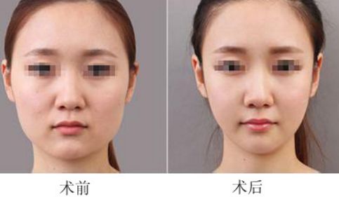 重慶面部吸脂能快速瘦臉嗎?