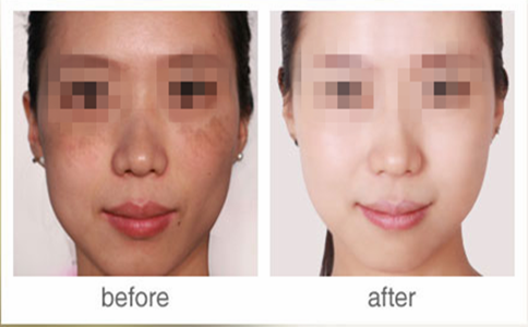 廣州光子嫩膚祛斑要多少錢?