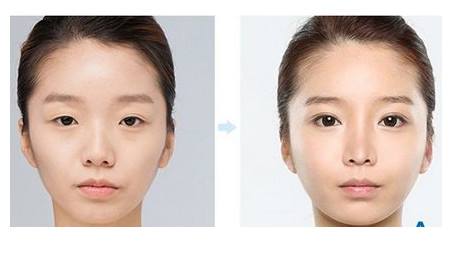 天津做上瞼下垂矯正的價格是多少?