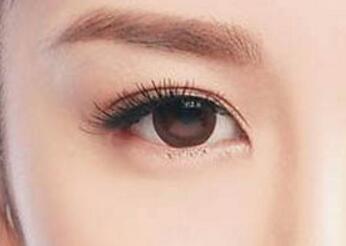 廈門開(kāi)眼角術(shù)后完全恢復(fù)需多久