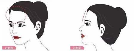 成都做自體脂肪面部填充可以維持十年嗎?