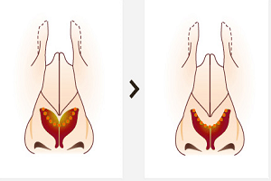 自體軟骨組織隆鼻有哪些優(yōu)點?