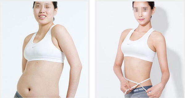 武漢做全身吸脂減肥手術要多少錢?