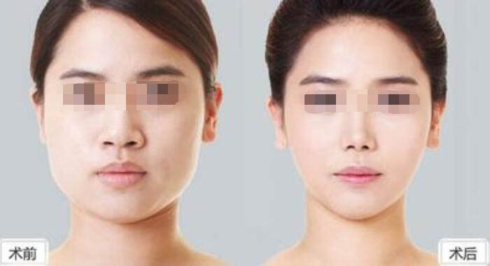 深圳吸脂減肥手術哪些部位可以做?