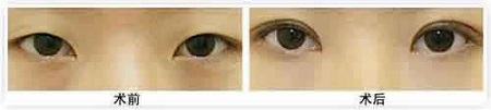 做雙眼皮到底怎么樣