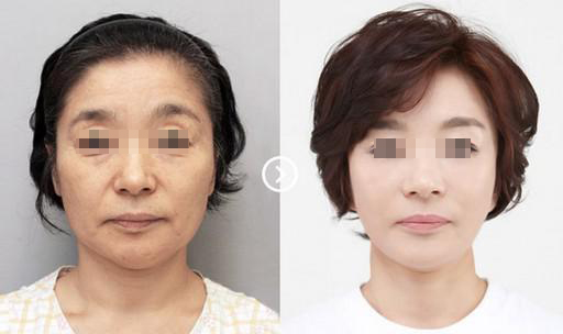 深圳激光除皺價格多少錢?能?徹底的去除嗎?