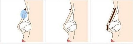 做假體隆鼻第二次對鼻子危害大嗎