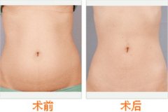 重慶做腹部吸脂手術(shù)多少錢(qián)?效果好嗎?
