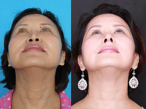 鼻孔大怎么辦？能做手術縮小嗎？