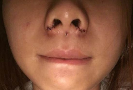 鼻孔大怎么辦？能做手術縮小嗎？