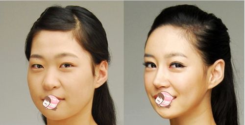 鼻頭縮小手術恢復時間要多長呢?