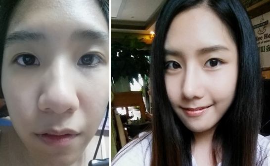 鼻頭縮小手術恢復時間要多長呢?