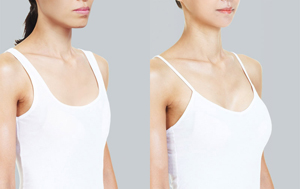 豐胸費用大概需要多少？