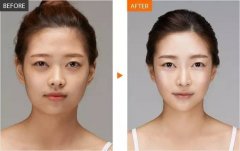 假體隆鼻術前有什么注意事項？