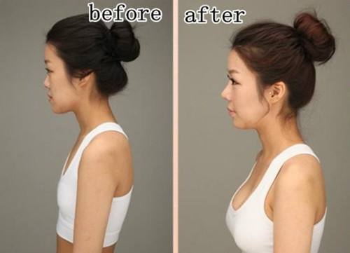 假體隆胸價格是多少?