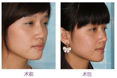 隆鼻后修復(fù)手術(shù)恢復(fù)時間會更長嗎?