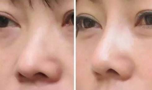 隆鼻后修復(fù)手術(shù)恢復(fù)時間會更長嗎?
