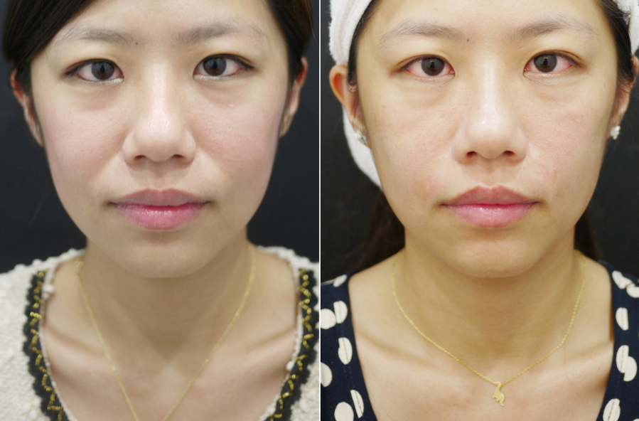 去法令紋有什么好辦法?