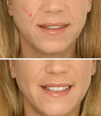 去法令紋有什么好辦法?