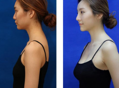 上海豐胸需要多少錢？