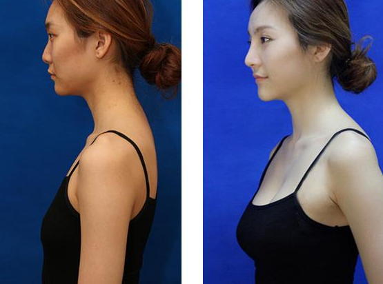 上海豐胸需要多少錢?