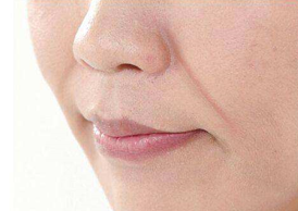 去法令紋有什么好辦法?