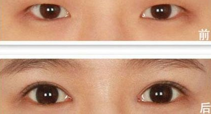 上眼瞼下垂怎么辦?