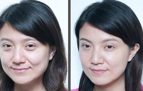 上眼瞼下垂怎么辦?