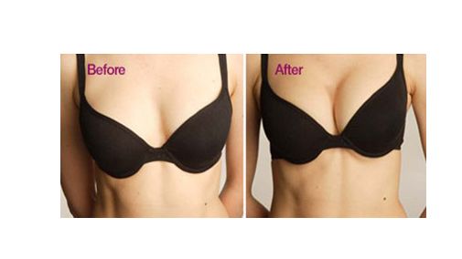 自體脂肪隆胸要注意什么?