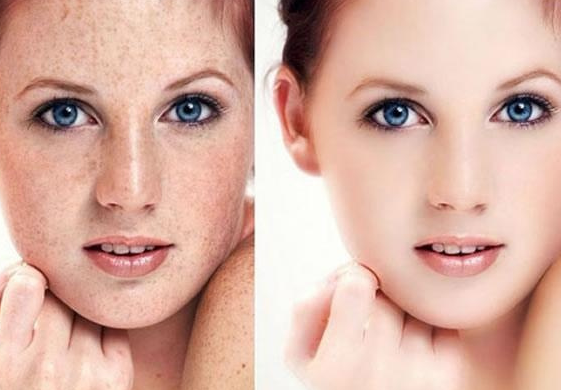 黃褐斑的形成是因為什么?