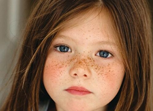 黃褐斑的形成是因為什么?