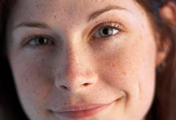 黃褐斑的形成是因為什么?