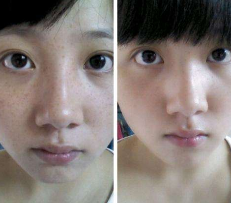 激光祛斑副作用大嗎?