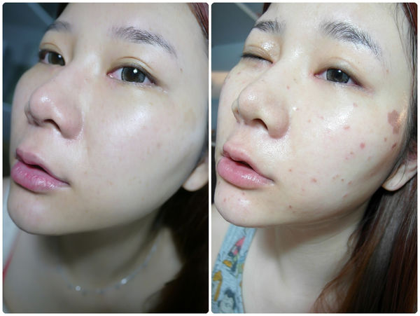 激光祛斑痛不痛?