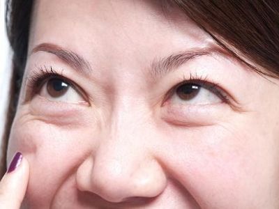 30歲就有眼袋怎么辦?