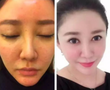 激光祛斑有效嗎？