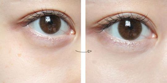 去眼袋方法都有什么?