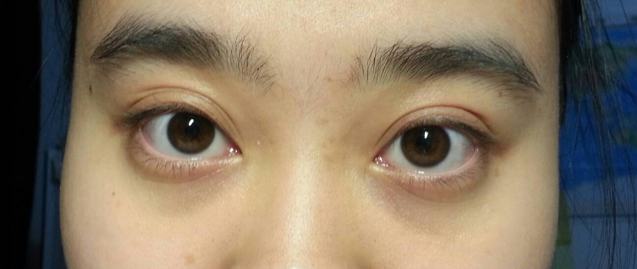 去眼袋方法都有什么?