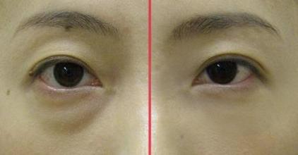 如何去除黑眼圈有妙招!