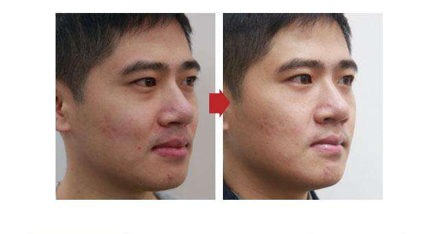 手術消除眼袋3大疑難問題解答!