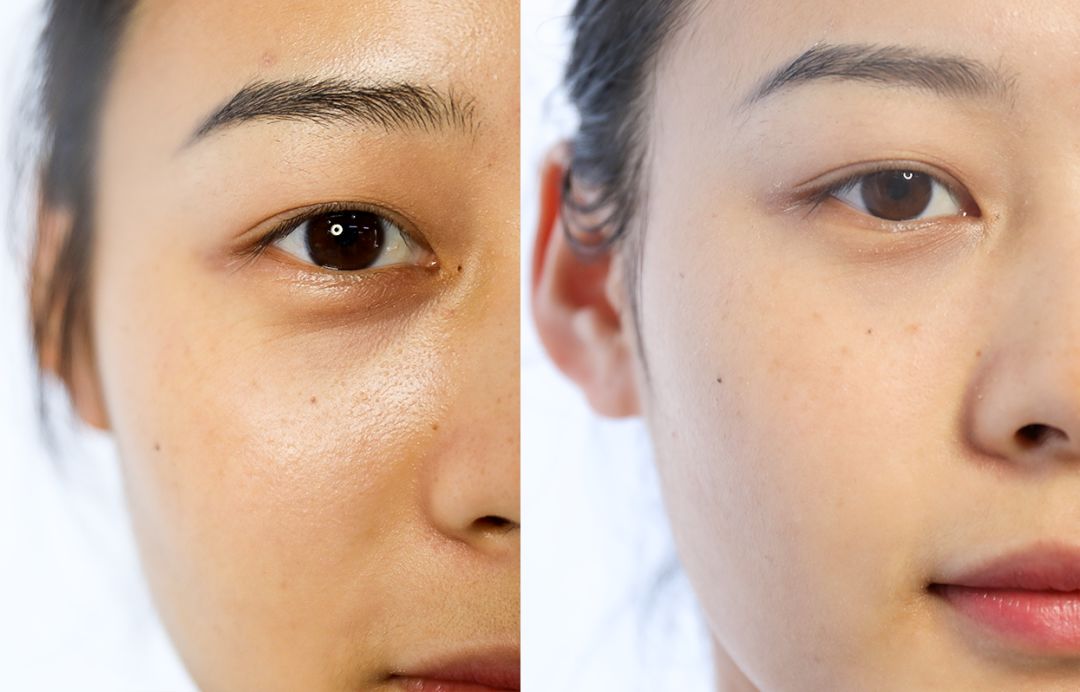 選擇激光去掉黑眼圈有什么注意事項?