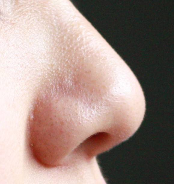 鼻子上有黑頭怎么辦?