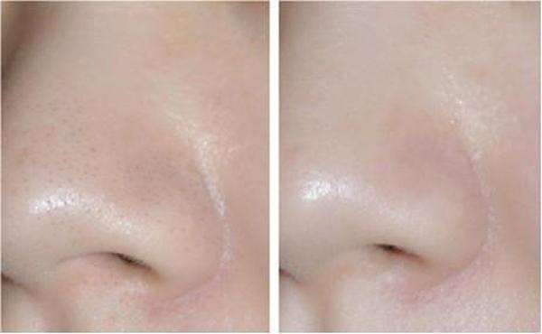 鼻子上有黑頭怎么辦?