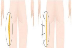 上海做大腿部吸脂效果好不好