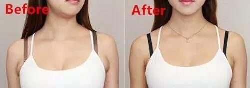 副乳怎么消除？