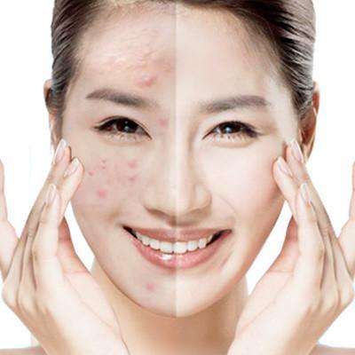 激光去痘后怎么護理?