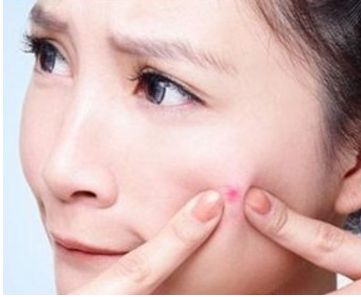 下巴上長痘痘是什么原因?怎么去除?