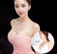 豐胸醫院怎么選？